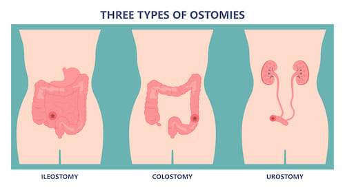 What is an Ostomy